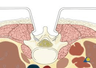 Traditional spine surgery