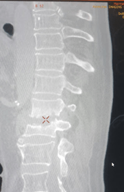 Spinal Infections