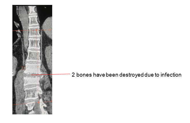 Spinal Infections