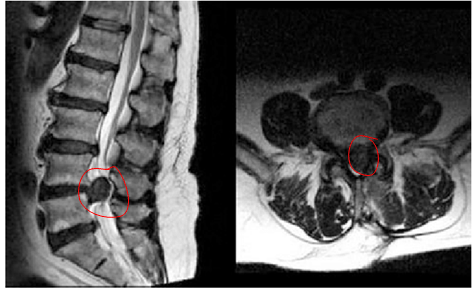 N Spinal fusion\TLIF