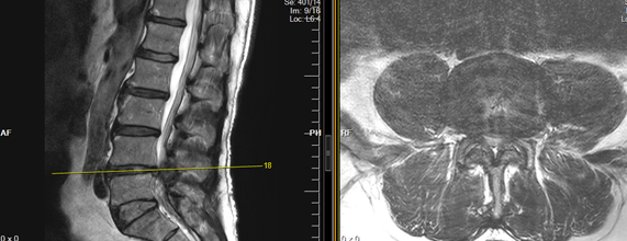 Lumbar canal Stenosis