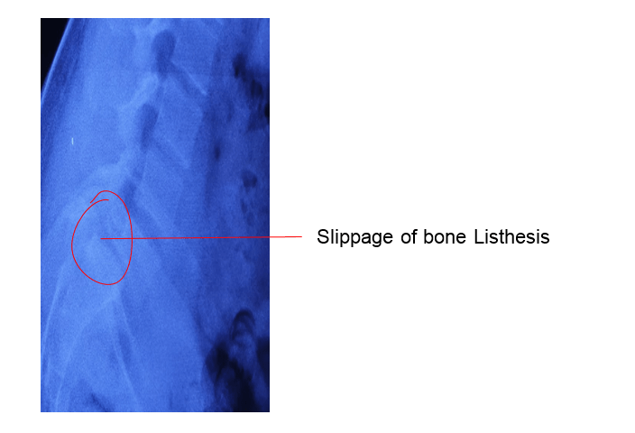slippage of bone