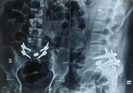 N Spinal fusion\TLIF