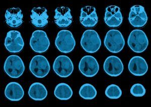 What is Meningioma? Symptoms, Diagnosis, & Treatment