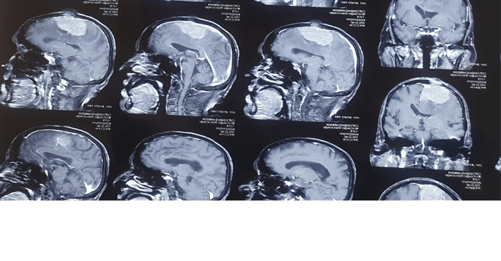 Large parasagital meningioma