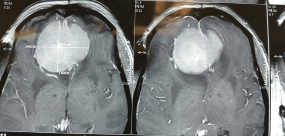 Spinal Meningioma