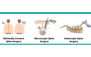 What is TLIF Surgery?